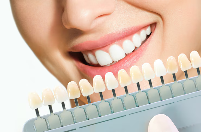 Bridge dentaire prix : comment obtenir la meilleure qualité au meilleur coût ?